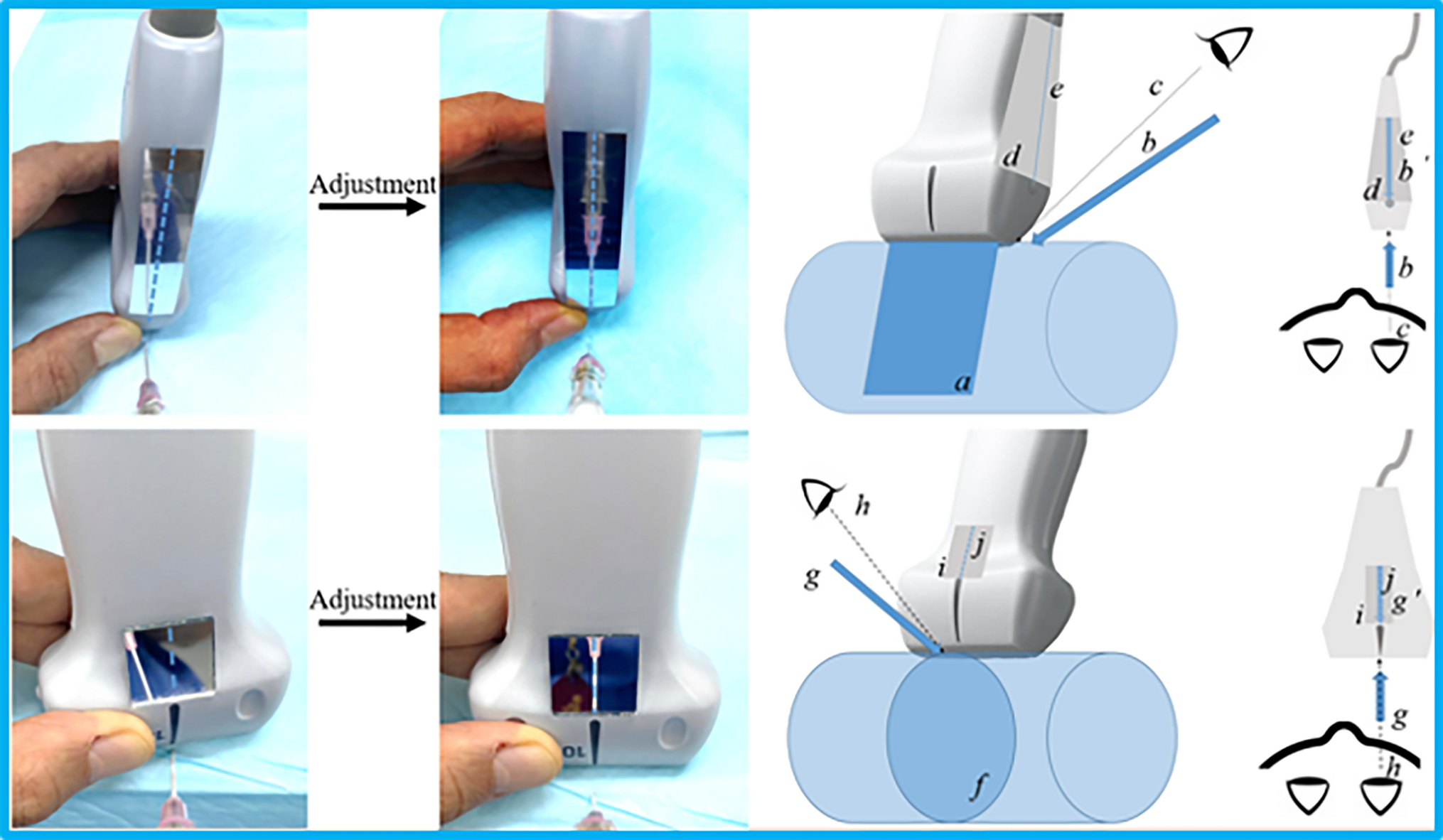 Enhancing needle visualization during ultrasound-guided procedures by attaching a mirror to the transducer