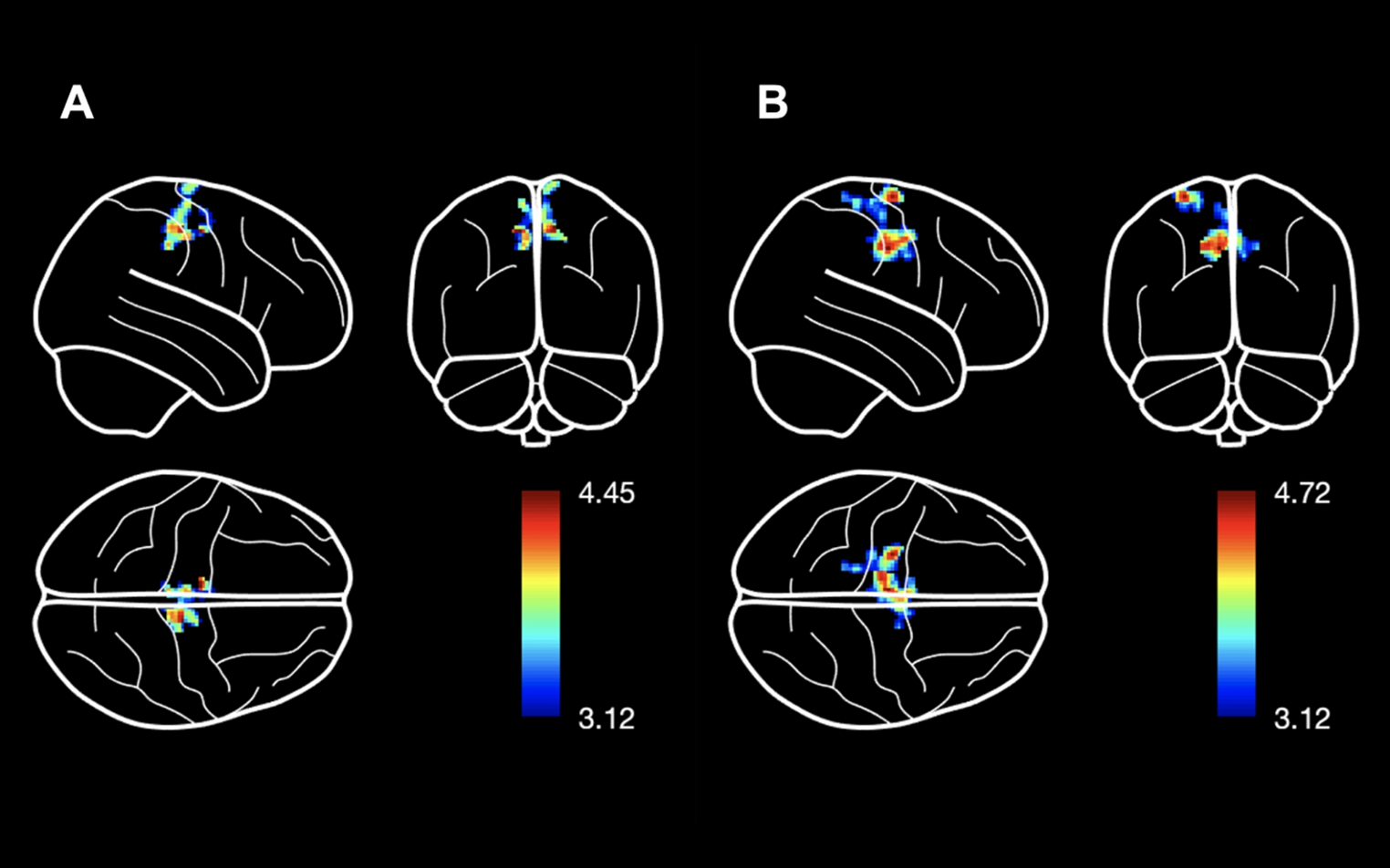Abnormalities of gray matter volume and structural covariance in children with attention-deficit/hyperactivity disorder subtypes: implications for clinical correlations