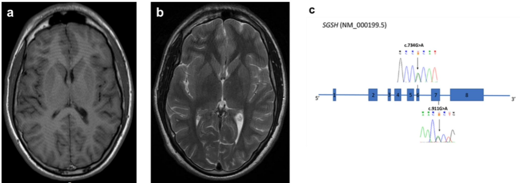 Acute transient psychotic episode as presenting sign of Mucopolysaccharidosis III A (Sanfilippo Syndrome type A) in an adolescent patient