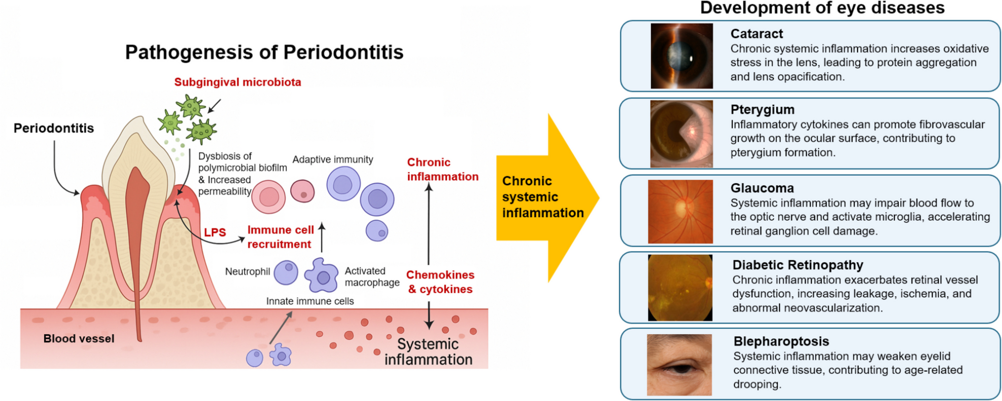 Systemic inflammation at the oral–ocular interface: a 3P medicine perspective on the relationship between periodontitis and eye diseases