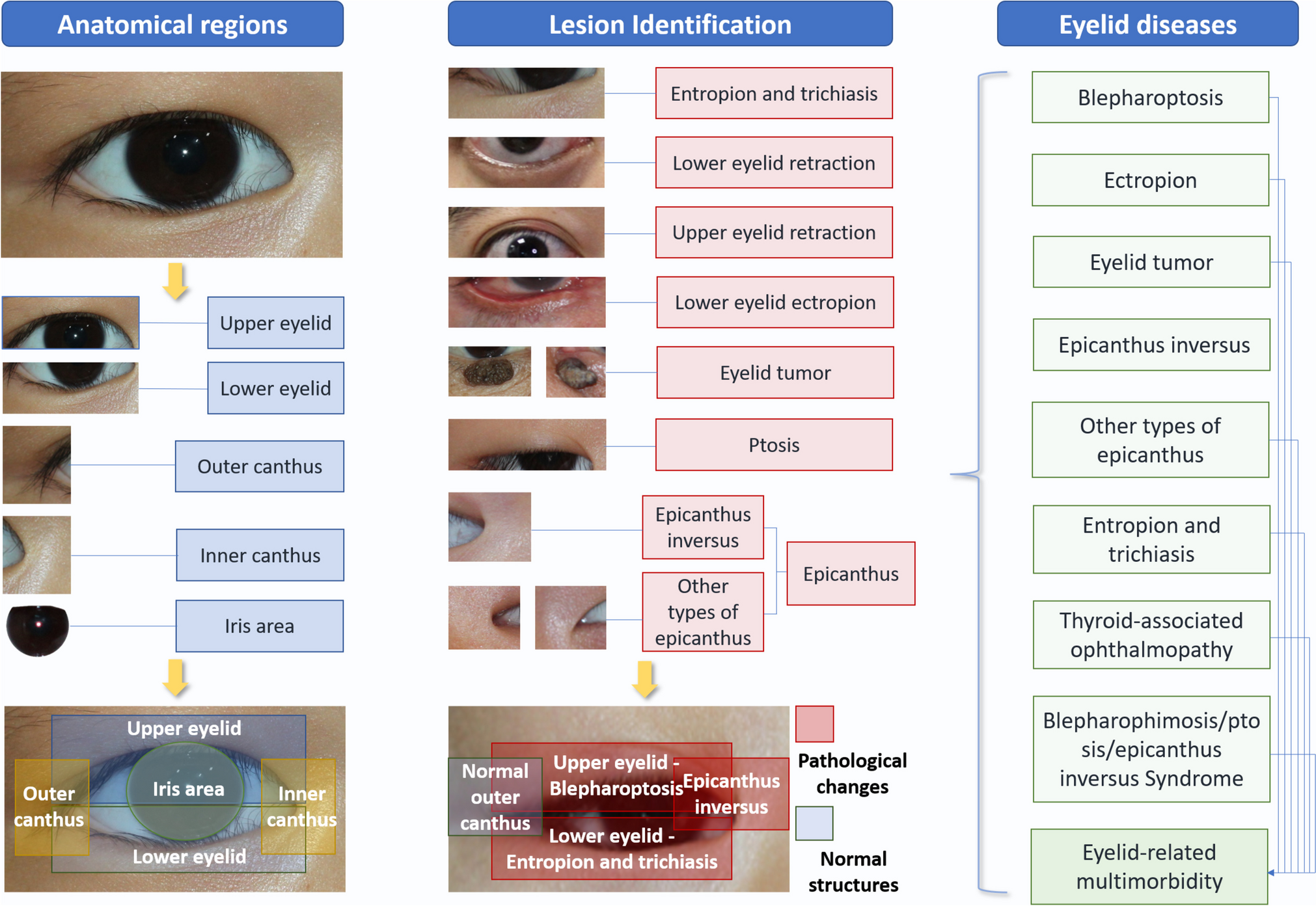 Advancing predictive, preventive, and personalized medicine in eyelid diseases: a concerns-based and expandable screening system through structural dissection