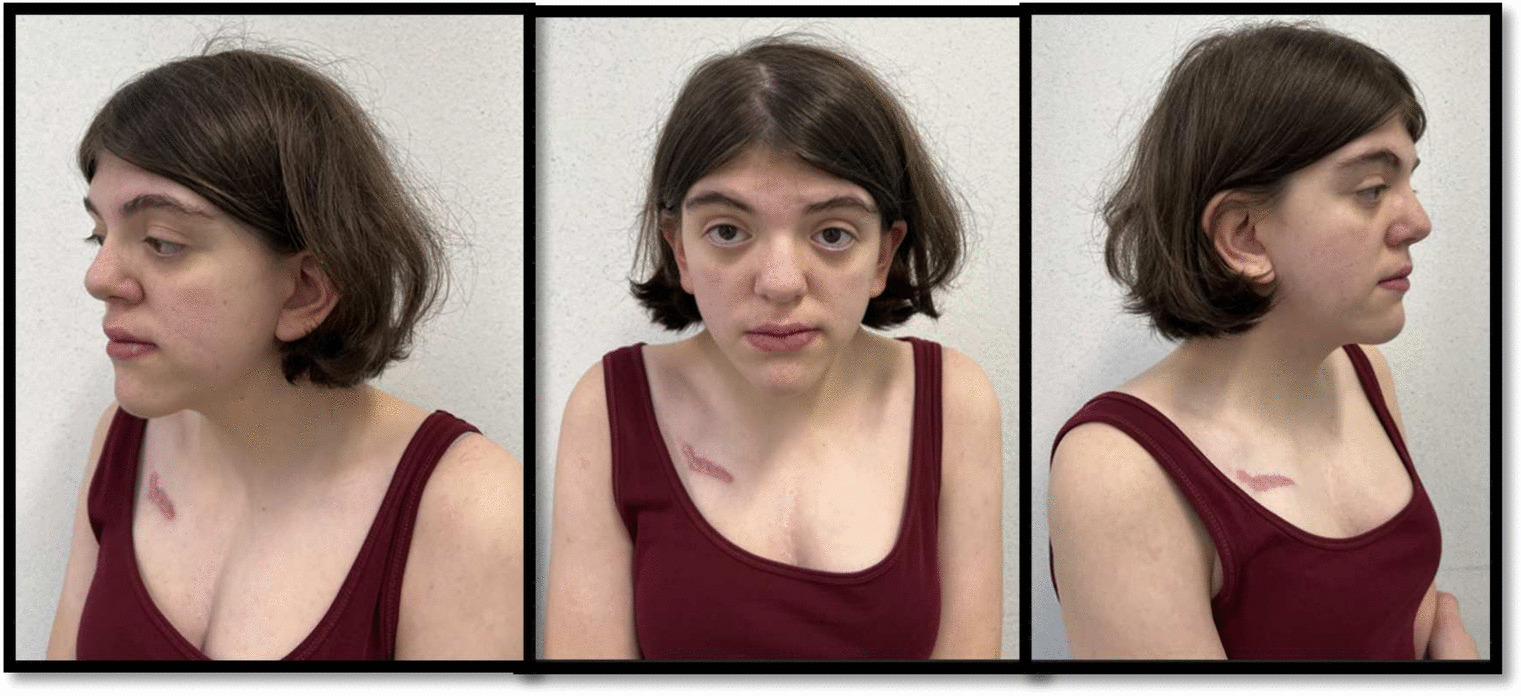 Expanding the knowledge about Thauvin-Robinet-Faivre syndrome: a case report with novel clinical findings and review of the literature