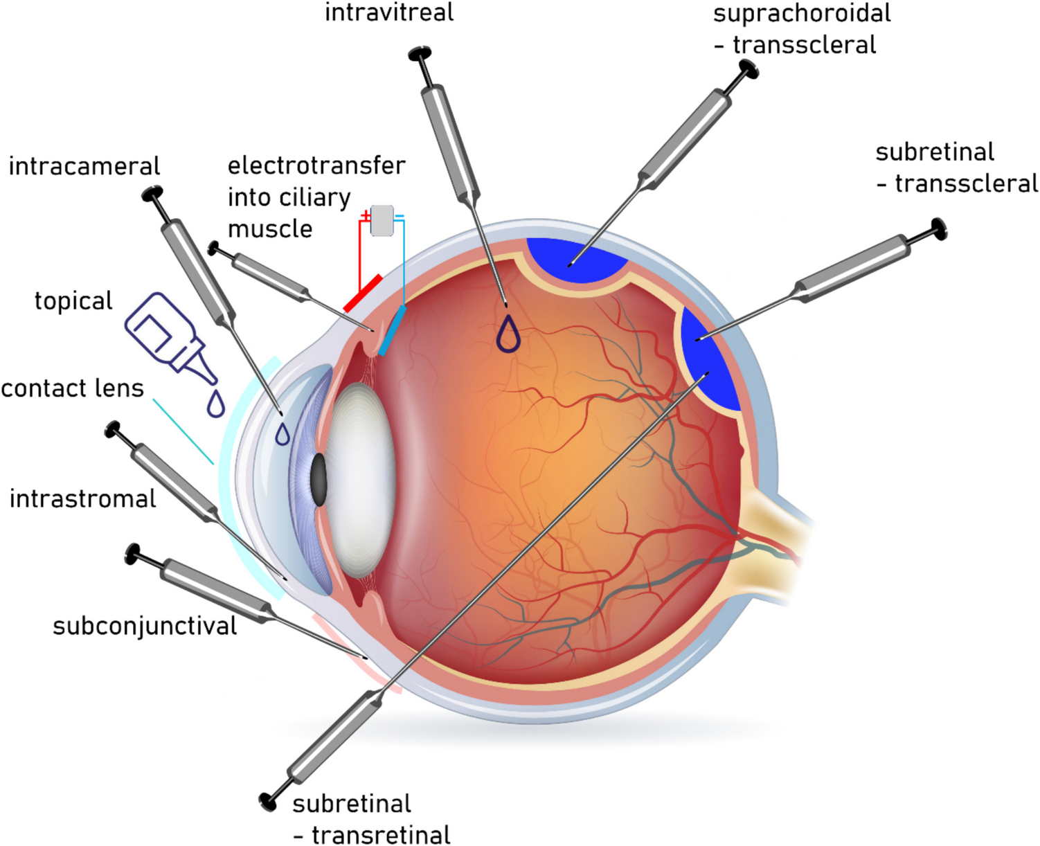 Gene therapy strategies in ophthalmology—an overview of current developments and future prospects