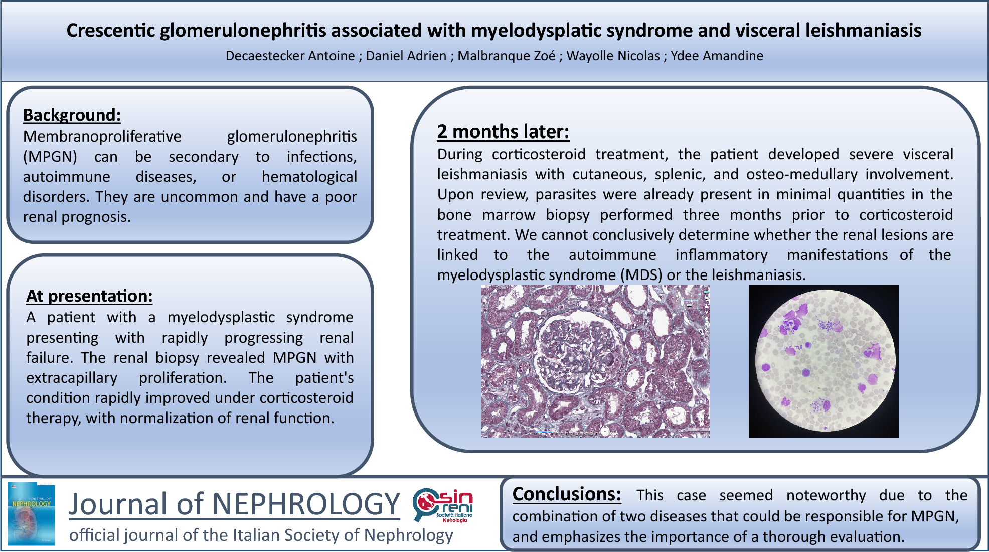 Crescentic glomerulonephritis associated with myelodysplatic syndrome and visceral leishmaniasis