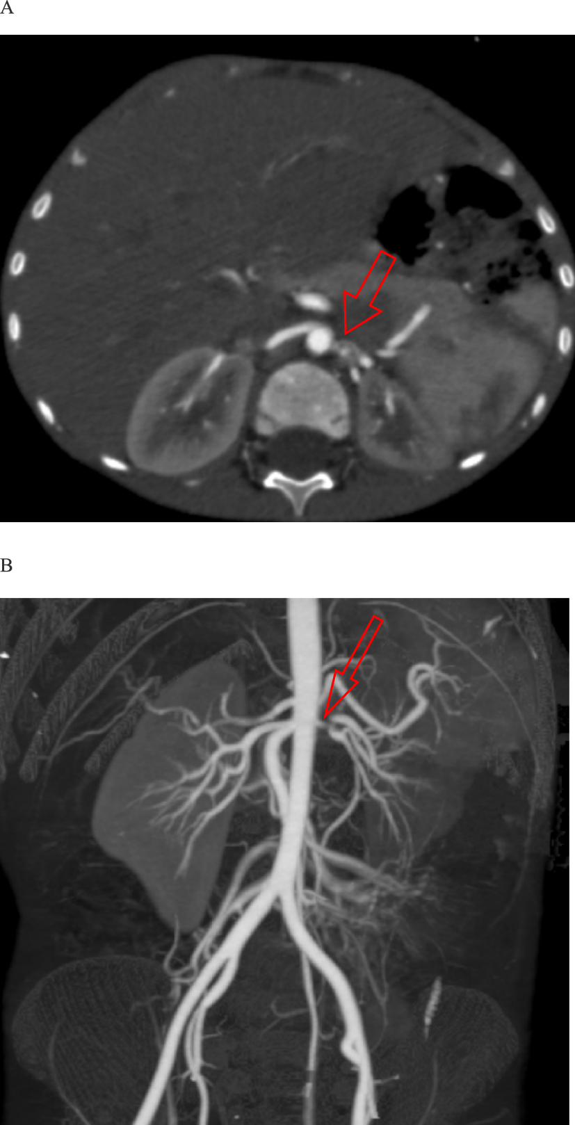 Lessons for the clinical nephrologist: unilateral renal artery stenosis presenting with hyponatremic hypertensive syndrome and posterior reversible encephalopathy syndrome in a child