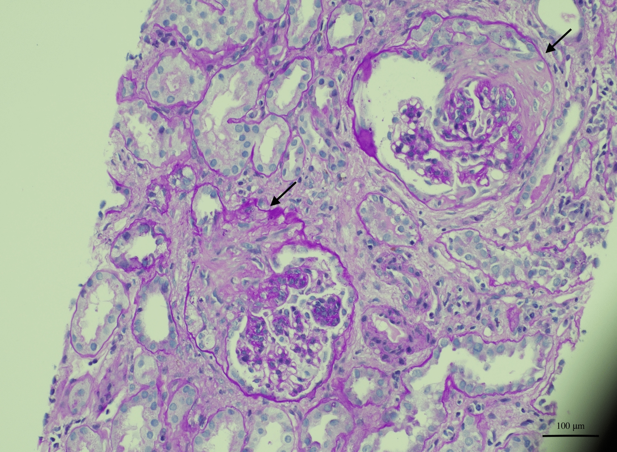 Lesson for the clinical nephrologist: IgA vasculitis as a paraneoplastic syndrome in a patient with sigmoid adenocarcinoma