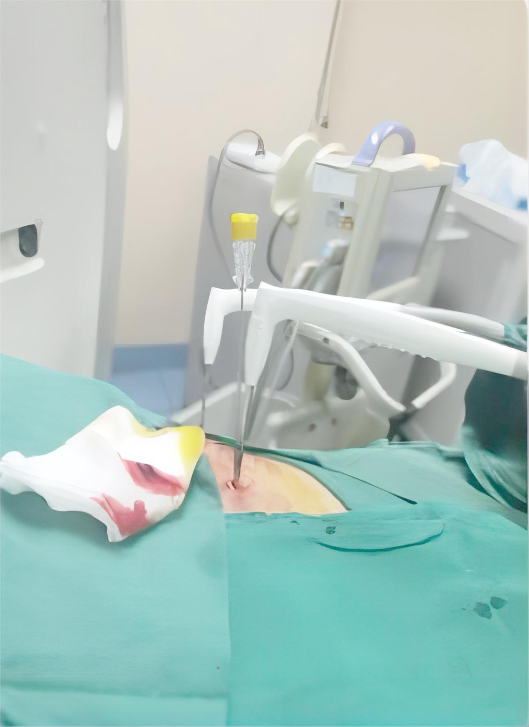 Efficacy and safety in synchronous core-needle biopsy and cryoablation for highly suspicious malignant pulmonary nodule