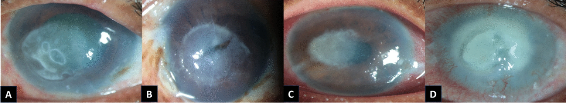 Emerging ocular pathogen: multidrug-resistant  in fungal keratitis: case series and literature review