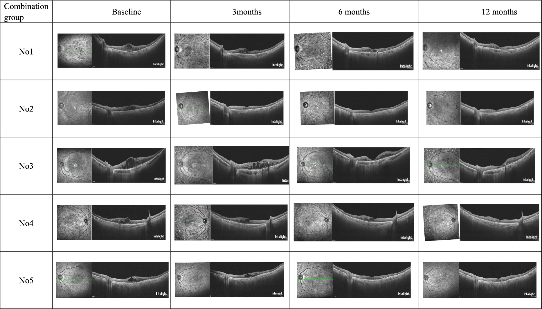 Early combined conbercept and dexamethasone implant therapy for diabetic macular edema