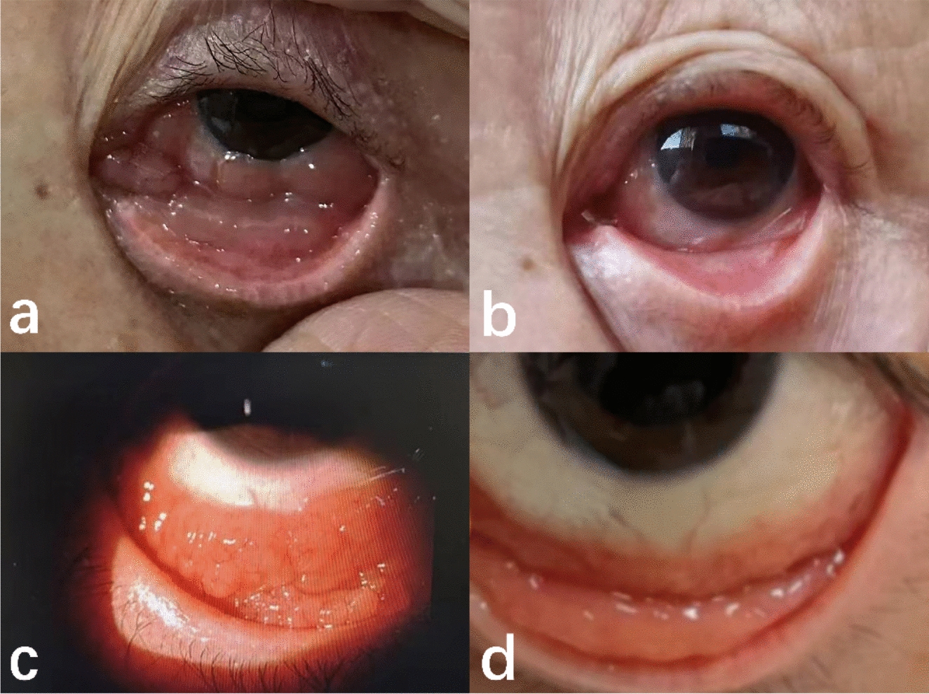 The clinical outcomes of ultra-low-dose radiotherapy for primary conjunctival mucosa-associated lymphoid tissue lymphoma