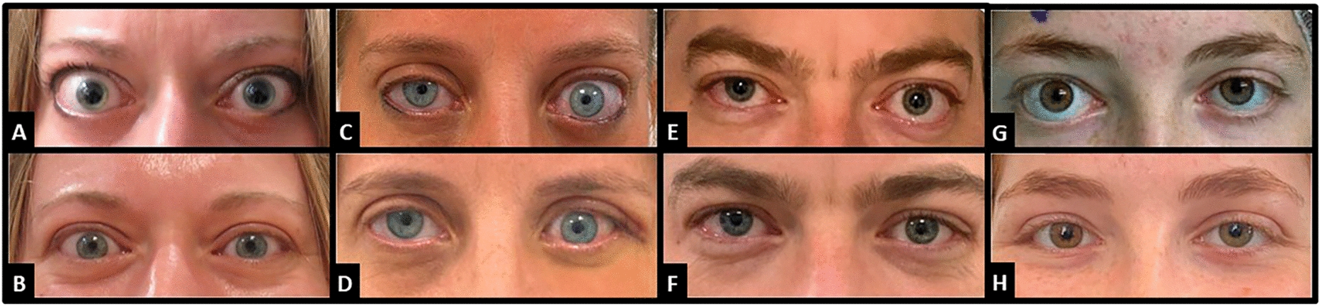 Medial wall orbital decompression surgery for the treatment of Graves’ ophthalmopathy: follow-up results in a single medical center
