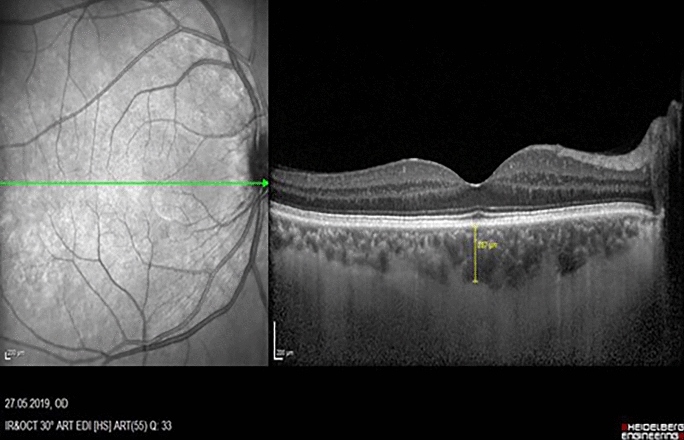 Effects of uncomplicated phacoemulsification surgery on retinal vascular diameters, subfoveal choroidal and central macular thickness