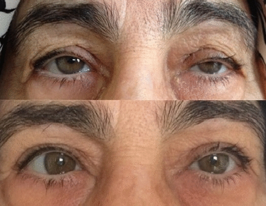 Postoperative outcomes in mitochondrial myopathy-associated ptosis: a case series