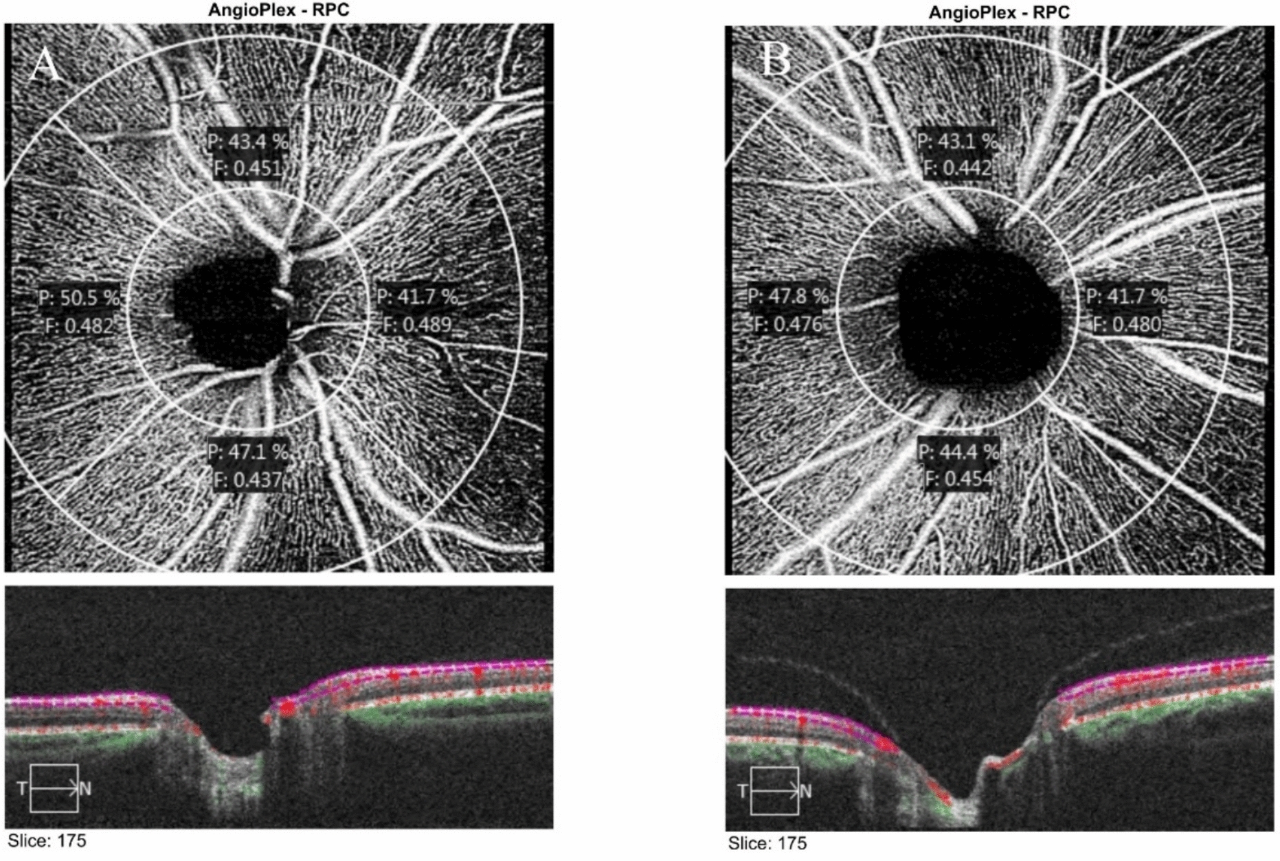 Effect of vitreopapillary interface adhesions on optic disc: an OCTA study