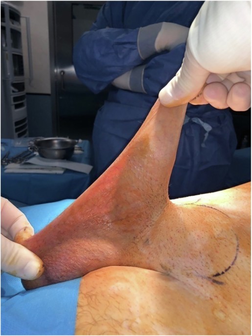 Penile length preservation in penile prosthesis placement: tips & tricks