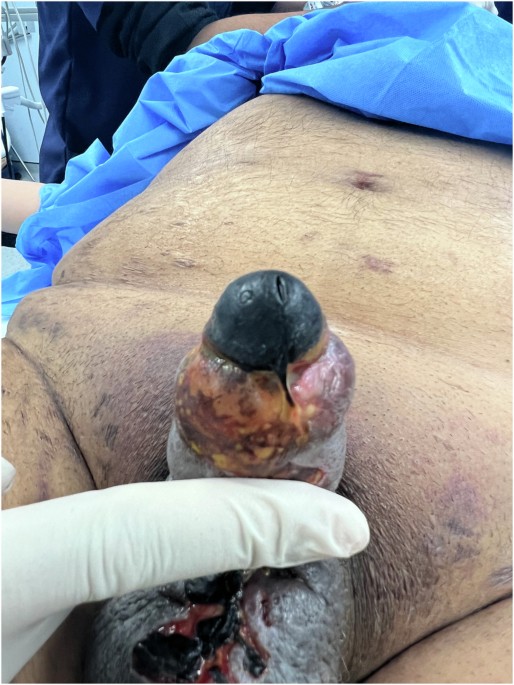 Diabetic patient with gangrene of the glans saved by minor debridement, topical hemoglobin spray, and hyperbaric oxygen therapy: a case report