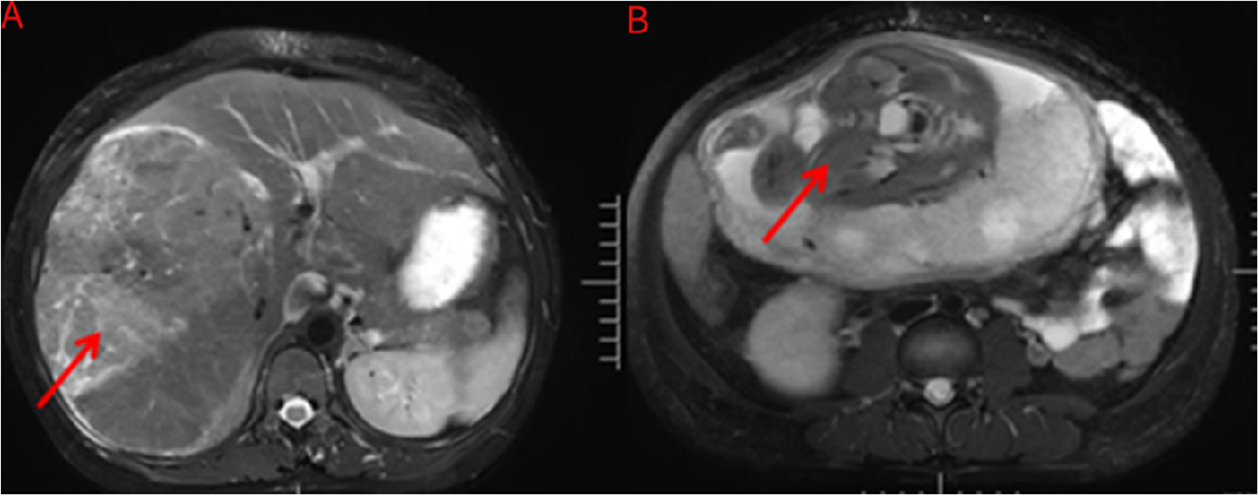 Successful resection of a huge hepatocellular carcinoma during pregnancy: case report and review of the literature