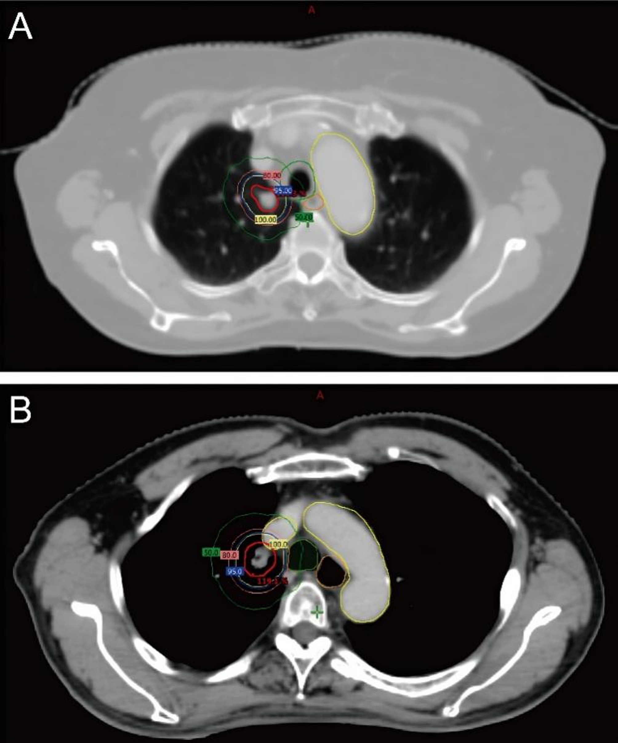 Optimizing stereotactic ablative body radiotherapy for ultra-central lung lesions: a comparative dosimetric analysis