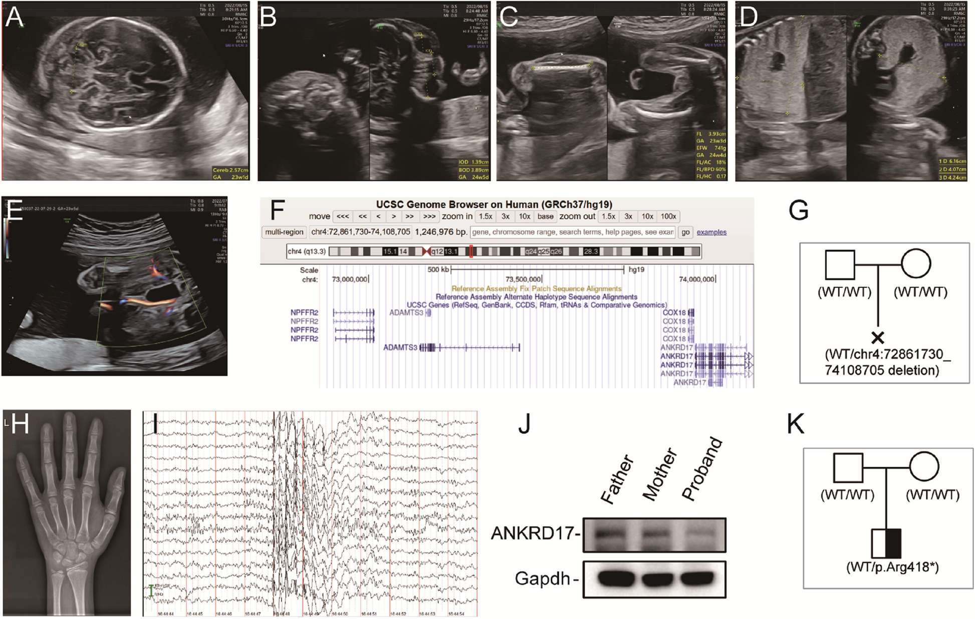 Novel ANKRD17 variants implicate synaptic and mitochondrial disruptions in intellectual disability and autism spectrum disorder