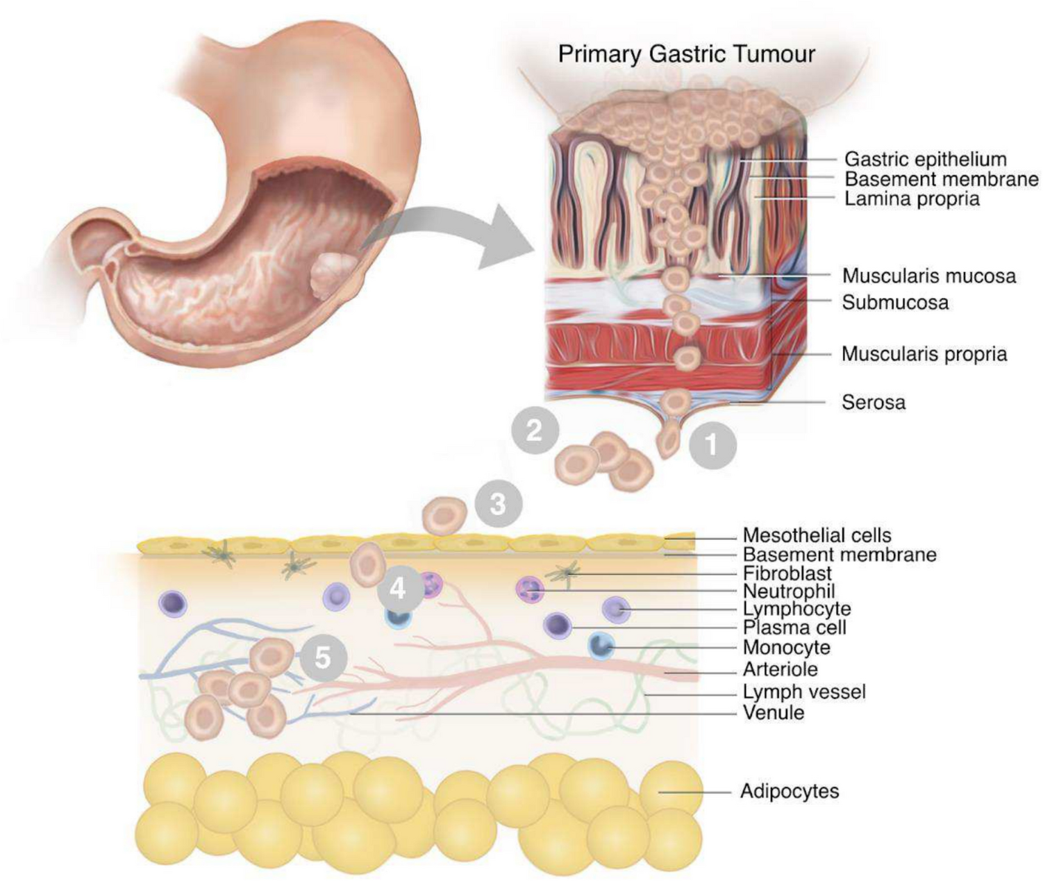 Molecular mechanisms of metastatic peritoneal dissemination in gastric adenocarcinoma