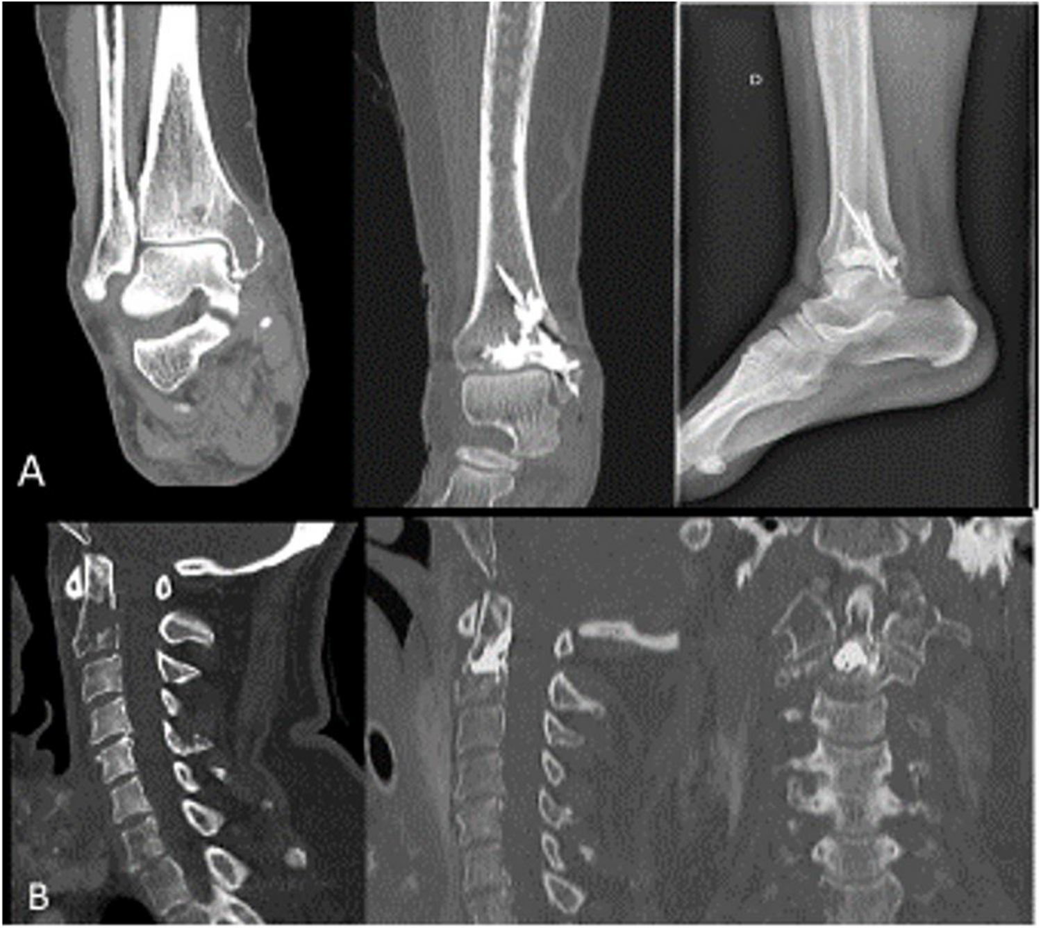 State-of-the-art of multidisciplinary approach of bone metastasis-directed therapy: review and challenging questions for preparation of a GEMO practice guidelines