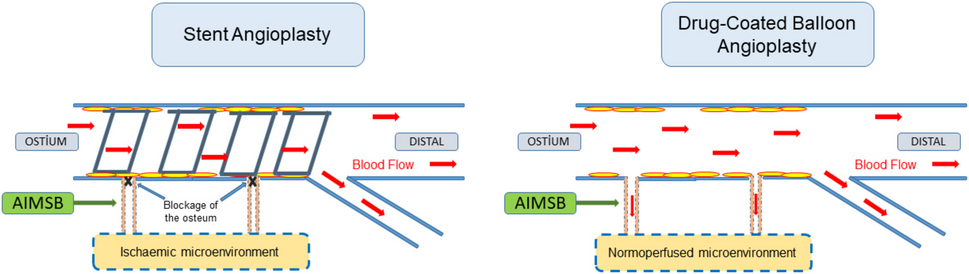 Impact of Percutaneous Coronary Interventions on Coronary Microvascular System: Coronary Stenting Versus Drug-Coated Balloon Angioplasty