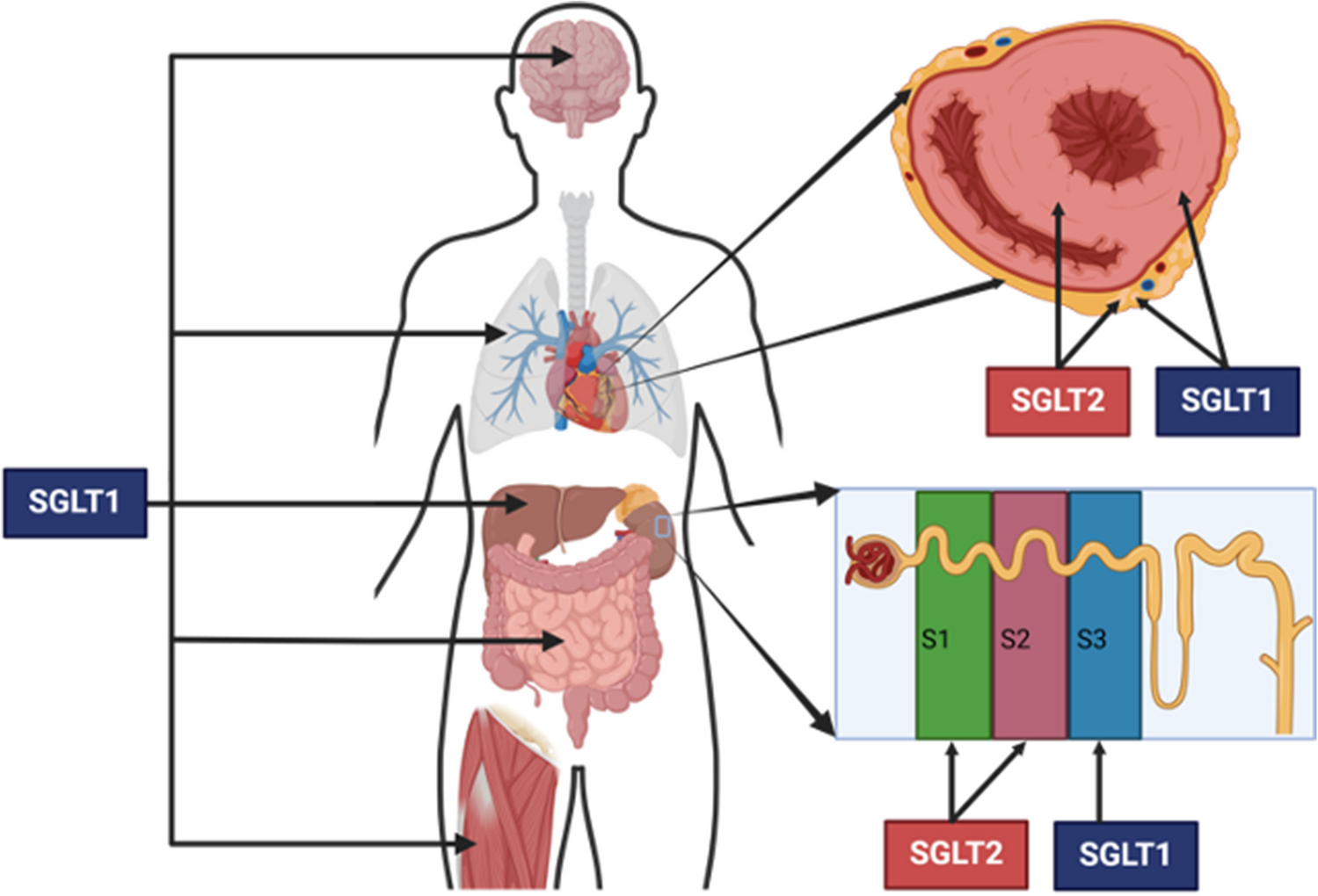 Sotagliflozin: Two Birds with One Stone?