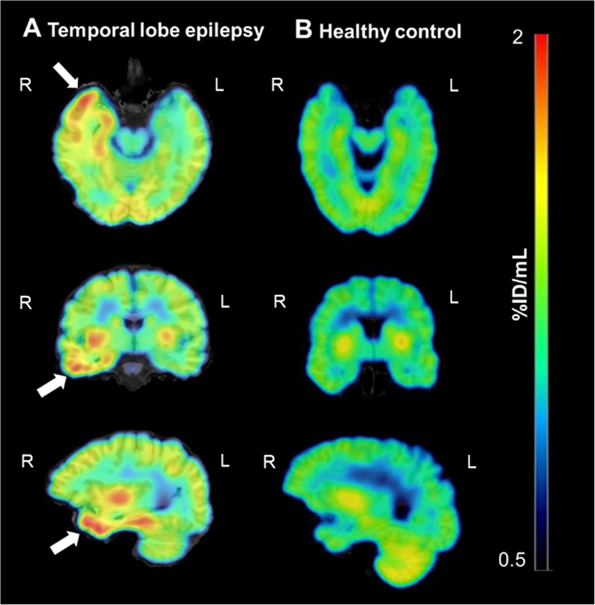 Imaging P-glycoprotein function at the blood-brain barrier in drug-resistant epilepsy using [C]metoclopramide