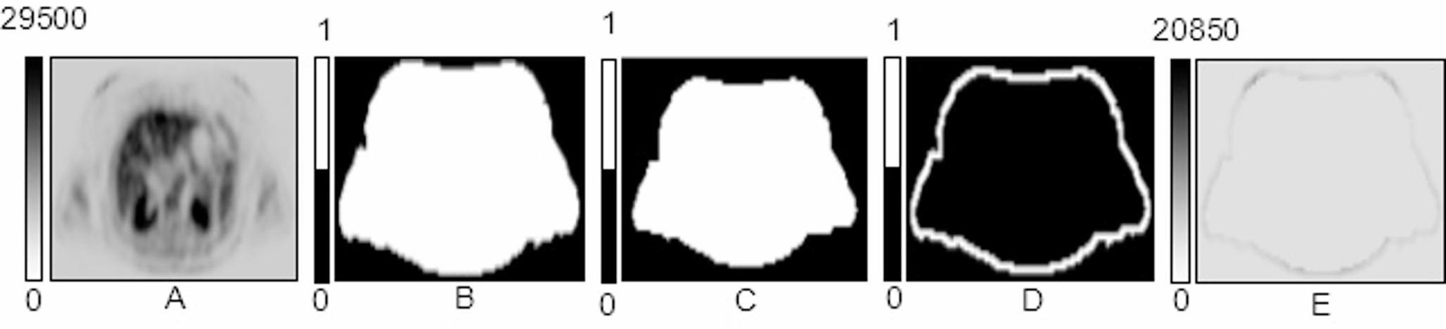 Virtual cutaneous area severity index (vCASI): A comprehensive methodology for quantitative skin disease assessment on positron emission tomography images