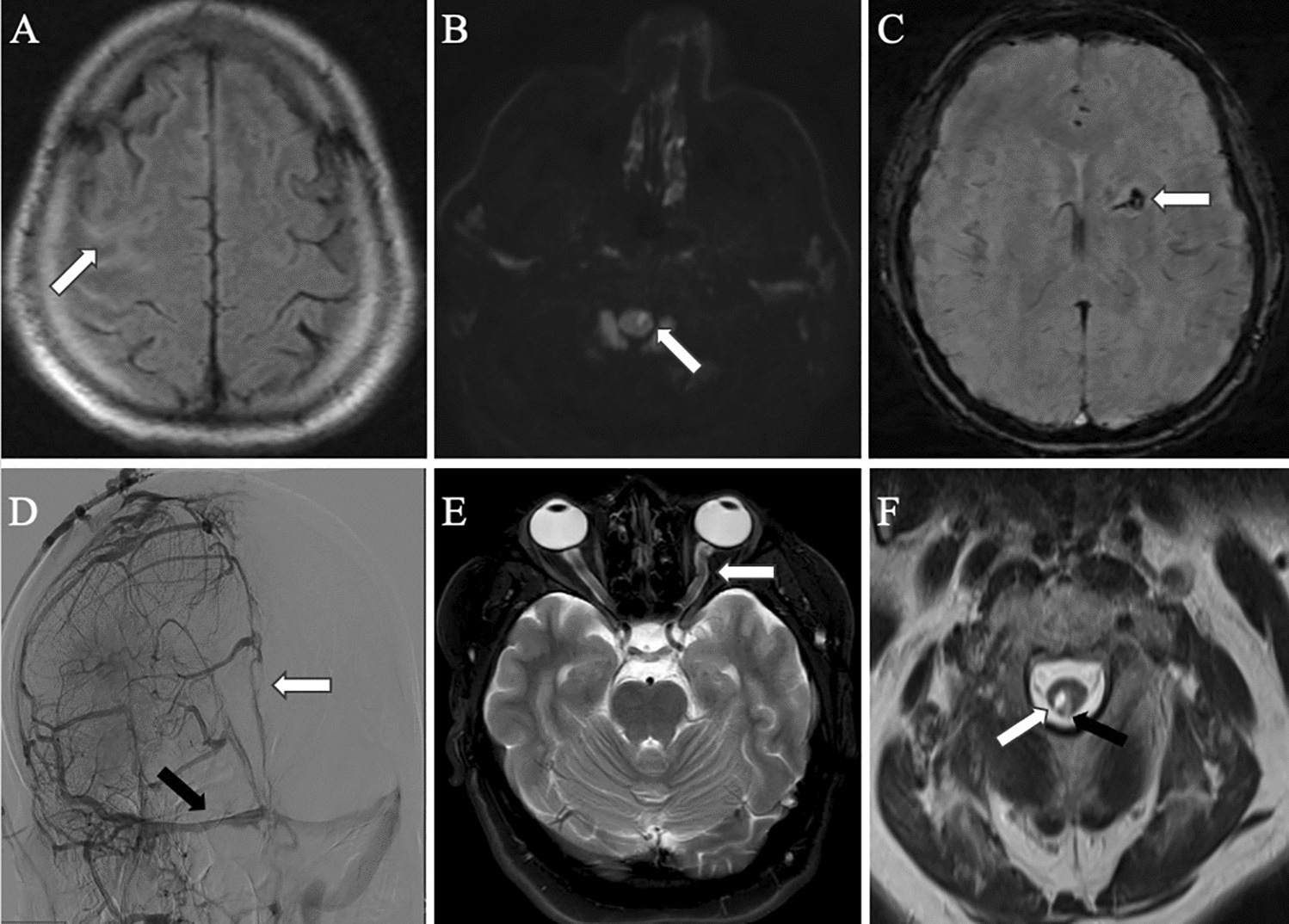 Central nervous system involvement and mimickers in ANCA associated vasculitis