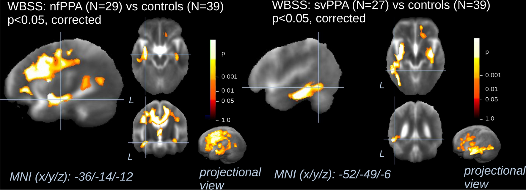 Multiparametric MRI-based biomarkers in the non-fluent and semantic variants of primary progressive aphasia