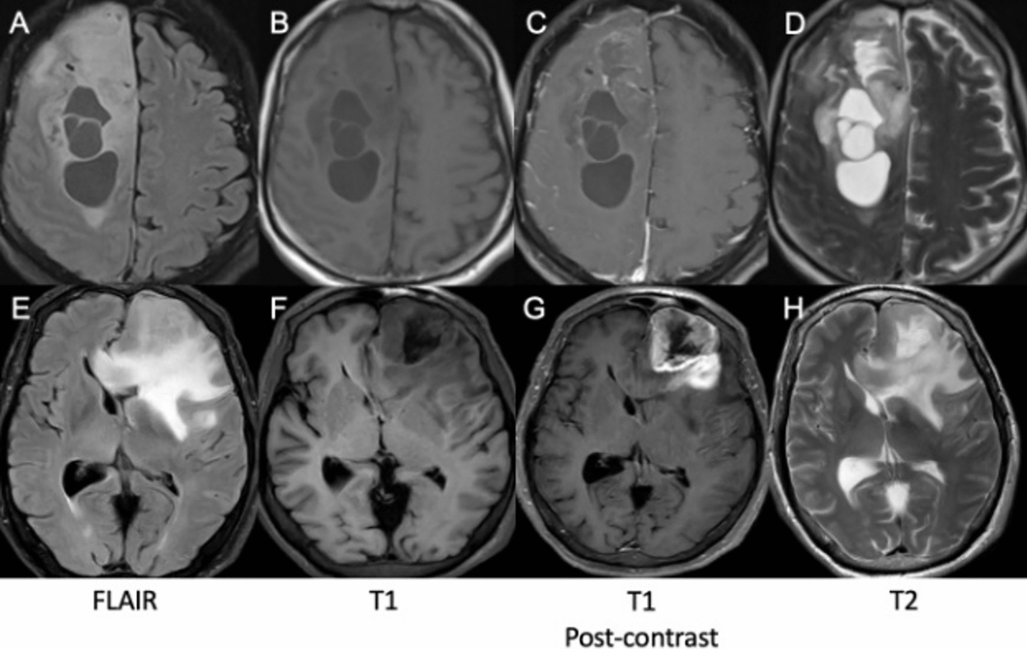 Cystic glioblastoma IDH-wildtype: genetic alterations and outcomes