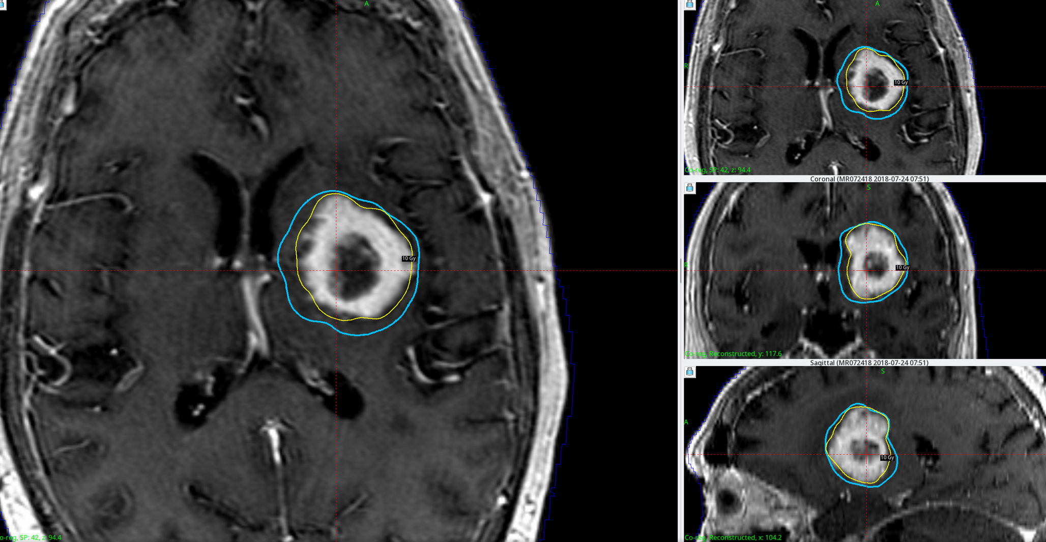 Evaluation of clinical and volumetric outcomes following adaptive gamma knife radiosurgery for brain metastases