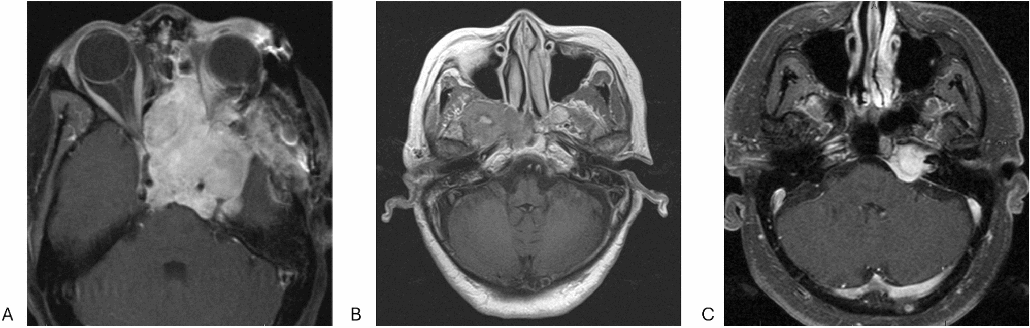 Management of skull base meningiomas with extracranial extension: resection, recurrence, and prognostic factors