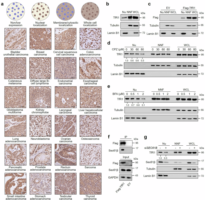 Transferrin receptor 1 nuclear translocation facilitates tumor progression via p53-mediated chromatin interactions and genome-wide alterations