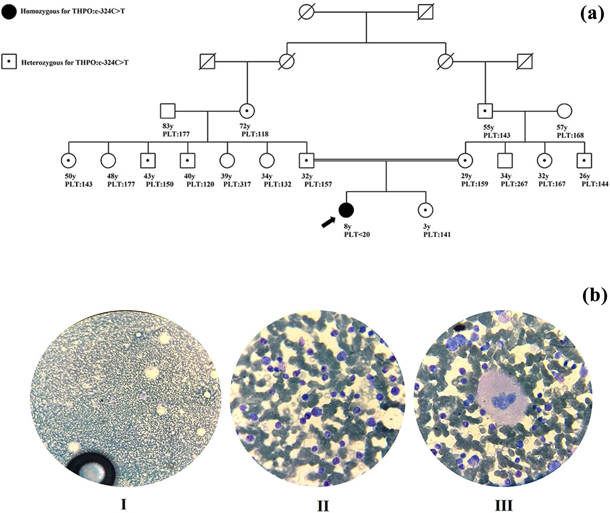 promoter mutation: a familial study on congenital amegakaryocytic thrombocytopenia