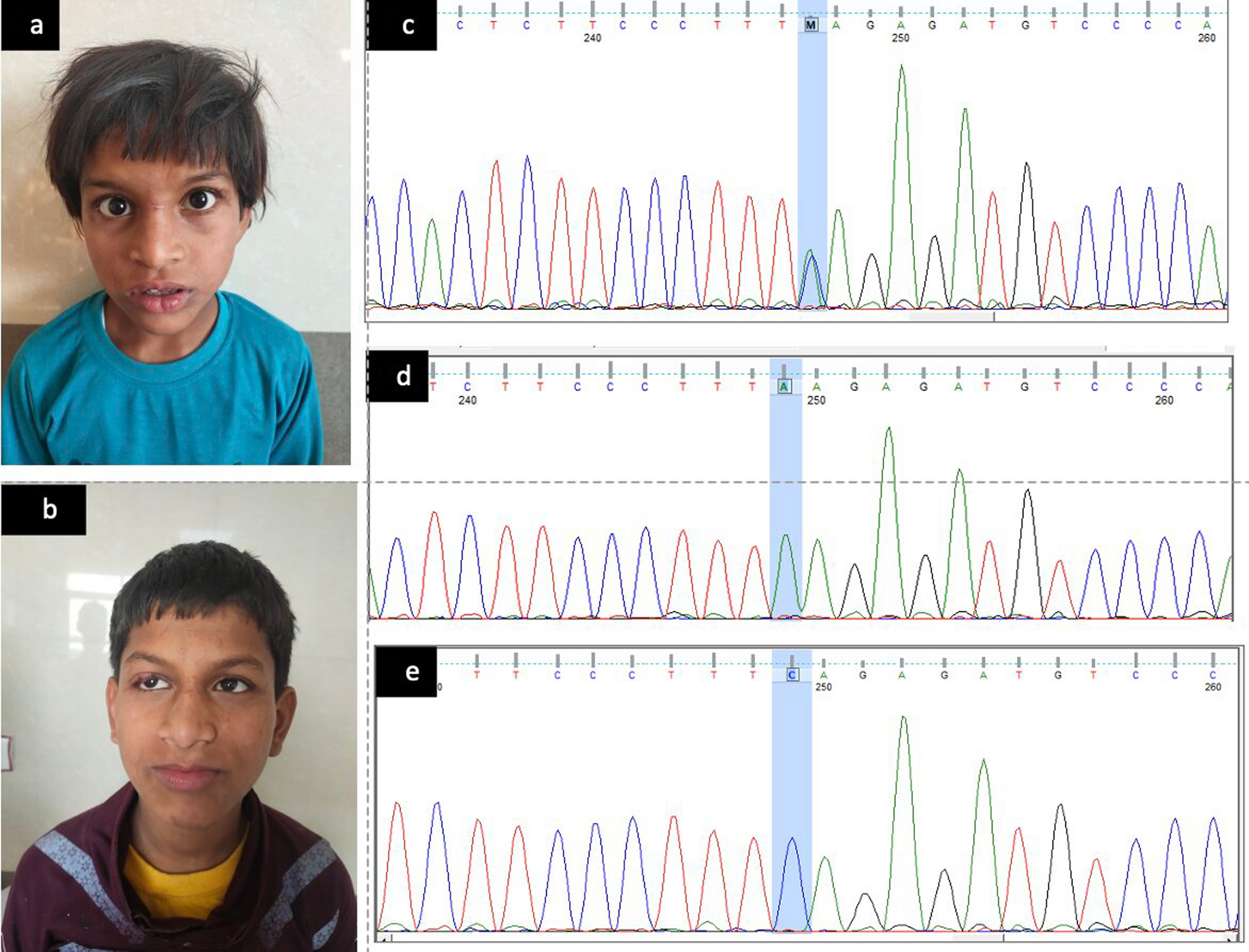 Gonadal mosaicism and paradoxical phenotype in  encephalopathy: a case report of two siblings