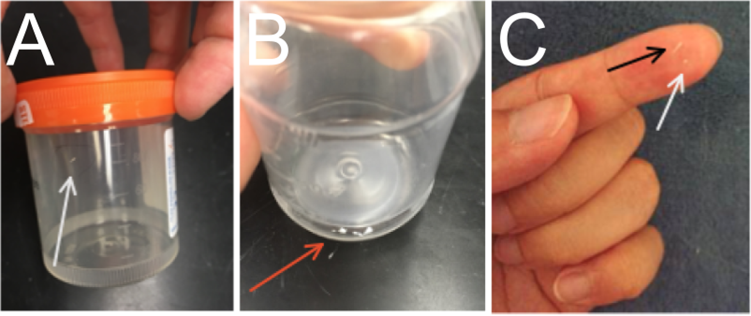 Recurrent Nipple Duct Obstruction in Two Breastfeeding Patients: A Case Report and Discussion of the Underlying Pathophysiology