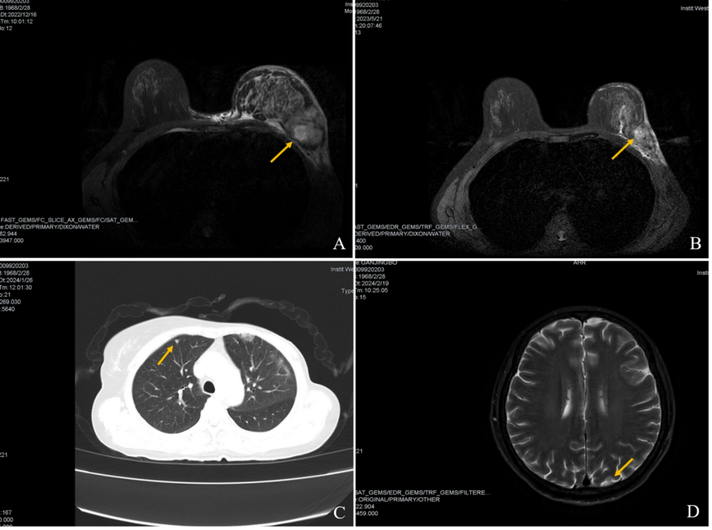 A rare case of HER2-positive pure metaplastic squamous cell carcinoma of the breast