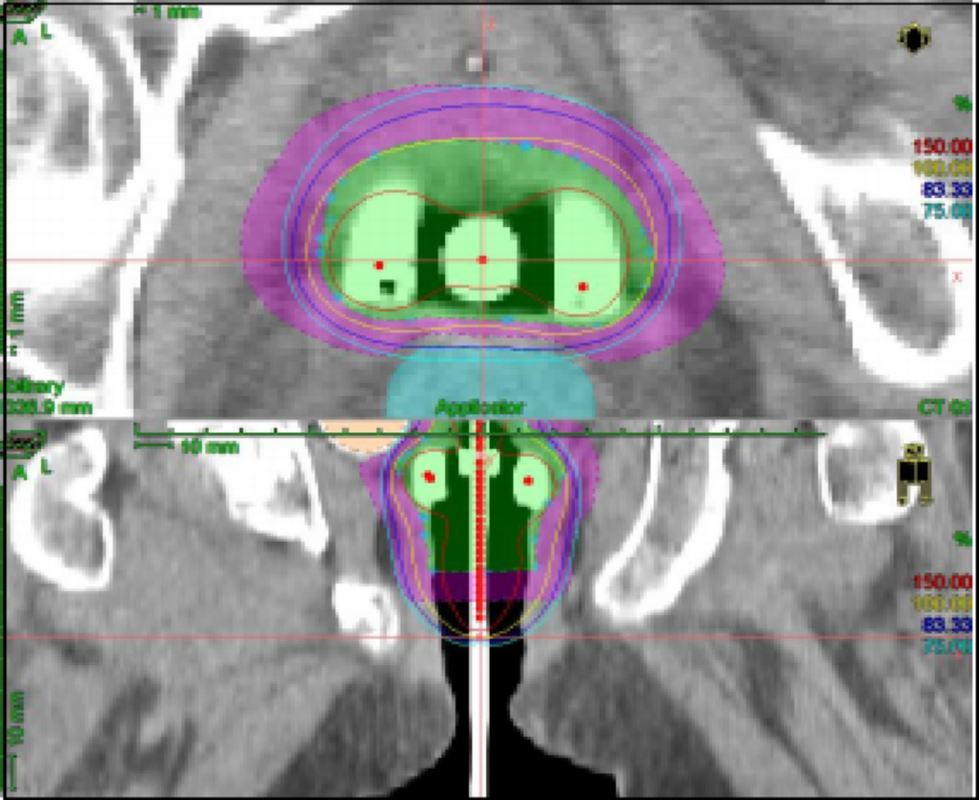 Comparison of differences in hematogenous metastasis among cervical cancer patients by CT-guided three-tube intracavitary brachytherapy and hybrid intracavitary and interstitial brachytherapy