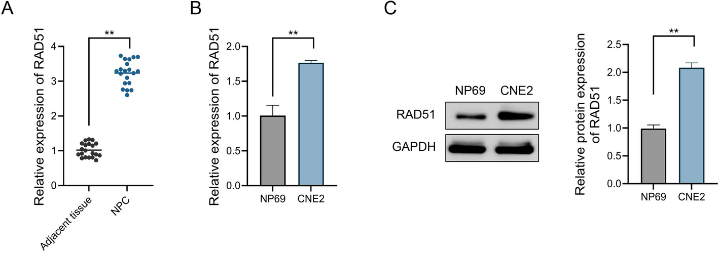 RAD51 modulates in nasopharyngeal carcinoma cells by regulating Caspase-8-mediated pyroptosis