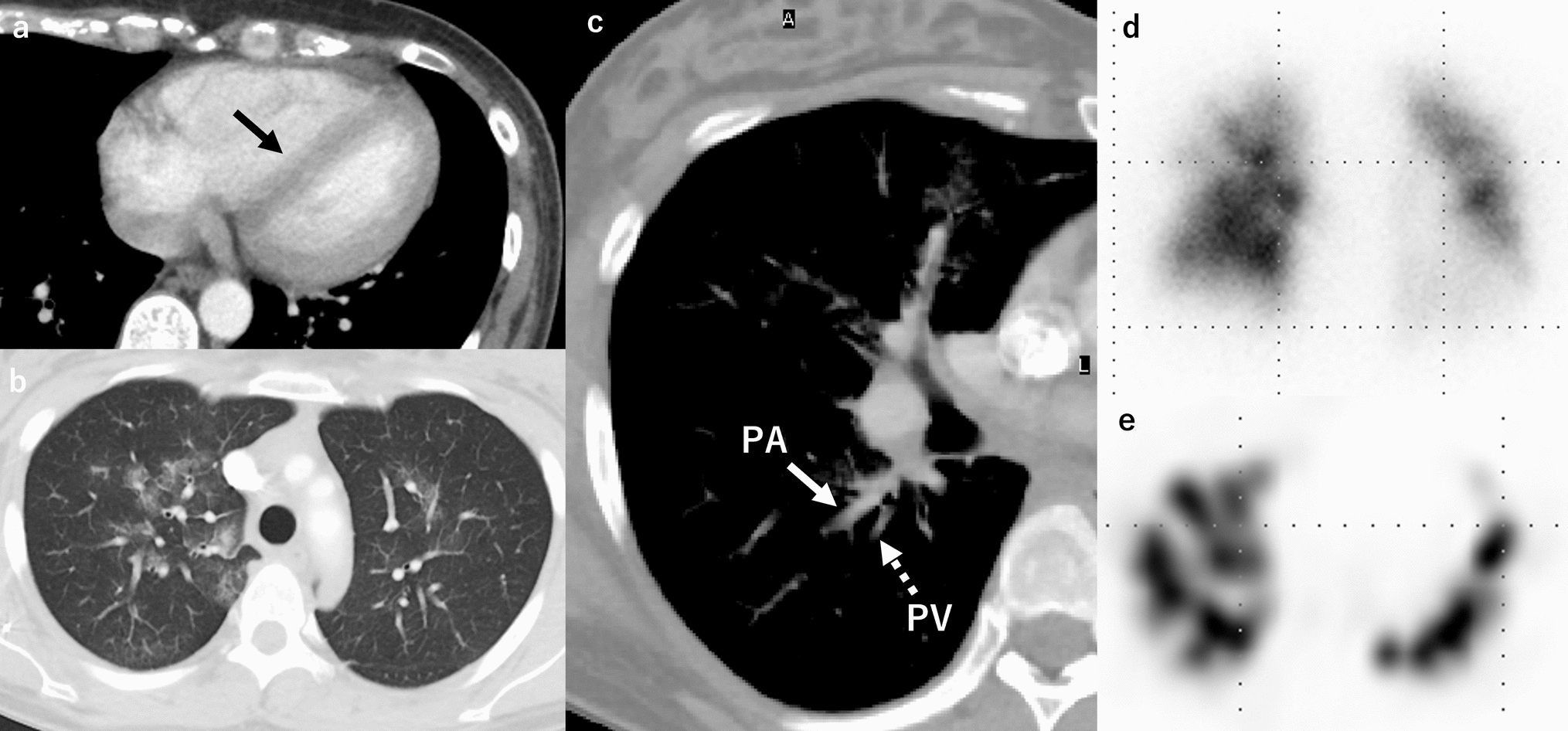 Non-thrombotic pulmonary emboli: imaging findings and differential diagnoses
