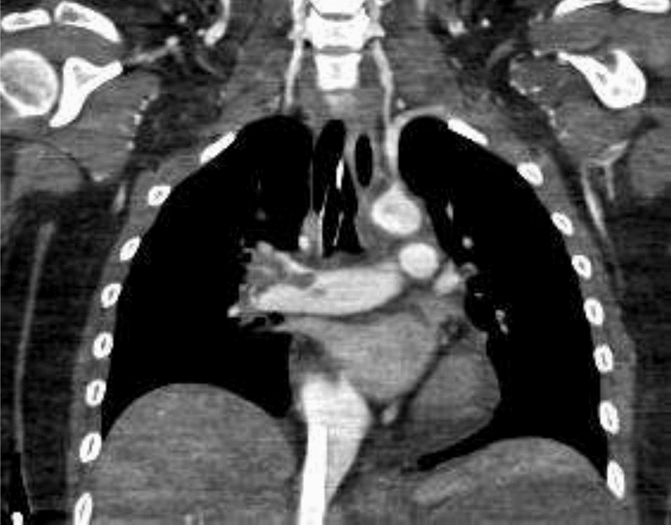 Comprehensive review of pulmonary embolism imaging: past, present and future innovations in computed tomography (CT) and other diagnostic techniques
