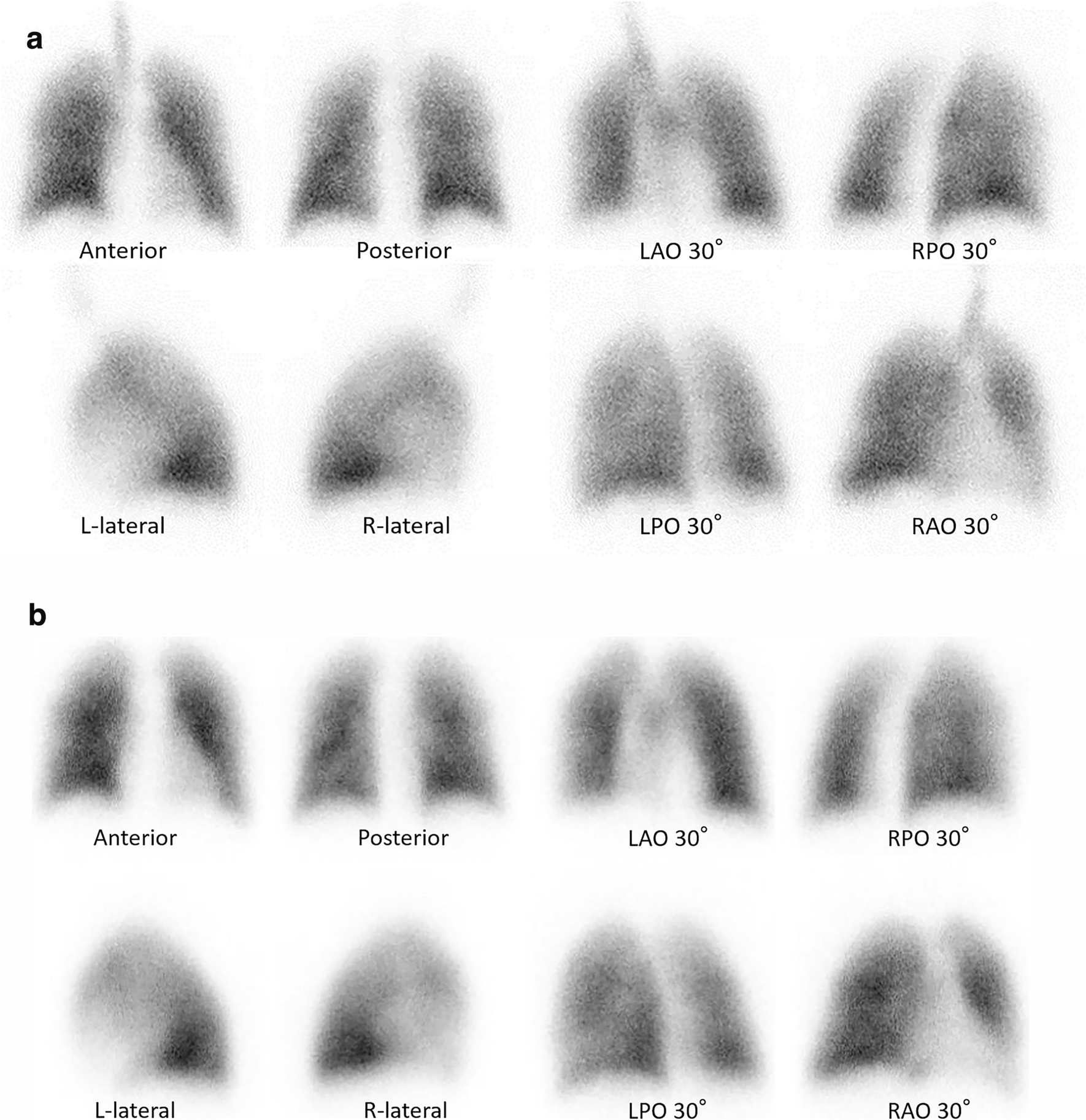 The clinical utility of ventilation–perfusion scintigraphy in the classification of pulmonary hypertension