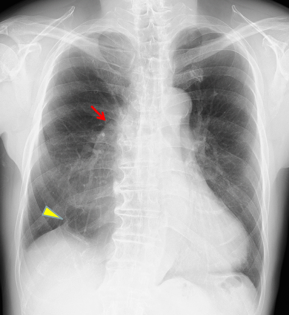Beyond resection: imaging findings of expected and complicated postoperative changes in lung cancer