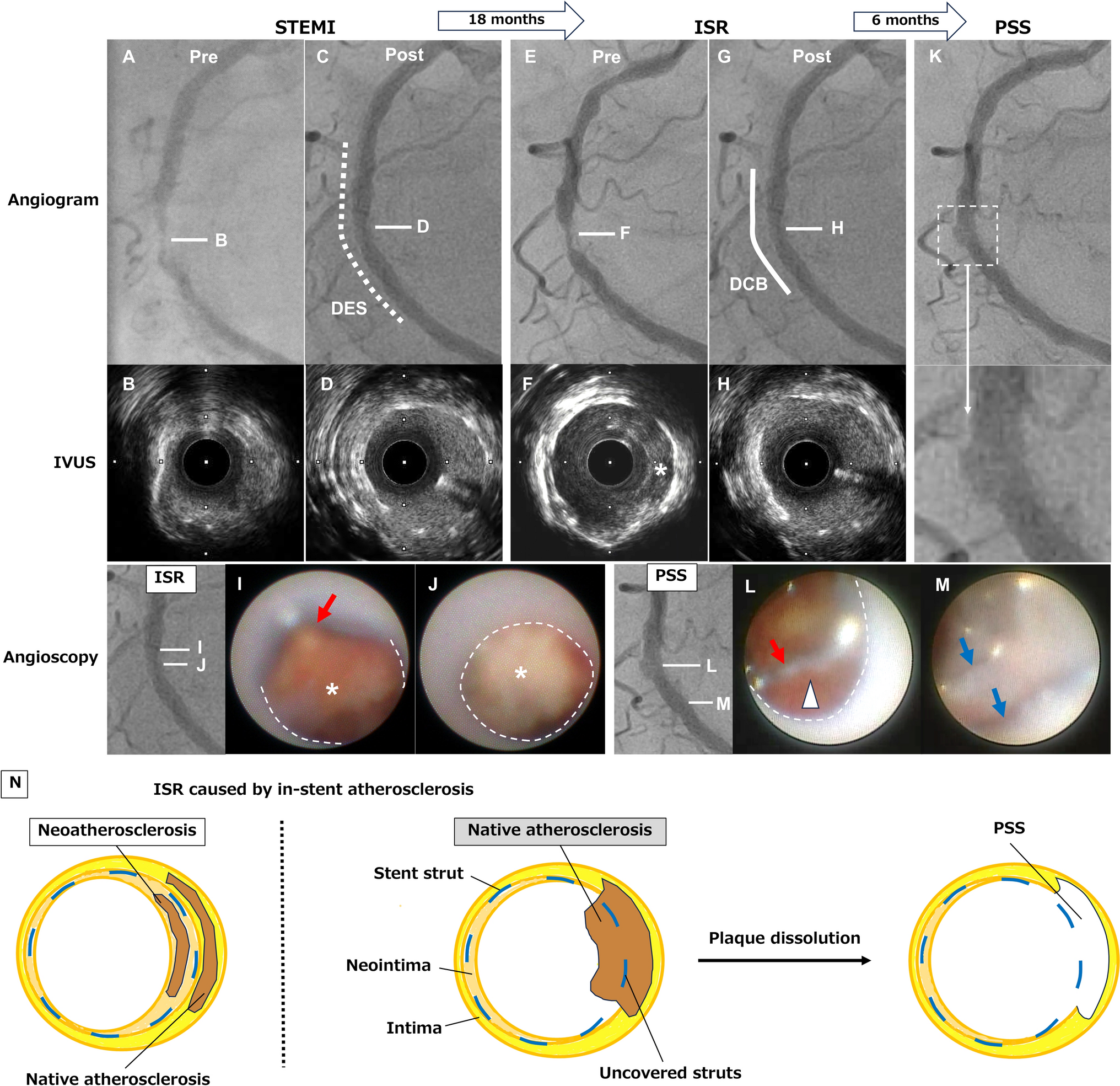In-stent restenosis caused by late-protruding native atherosclerosis through uncovered struts: observations with coronary angioscopy