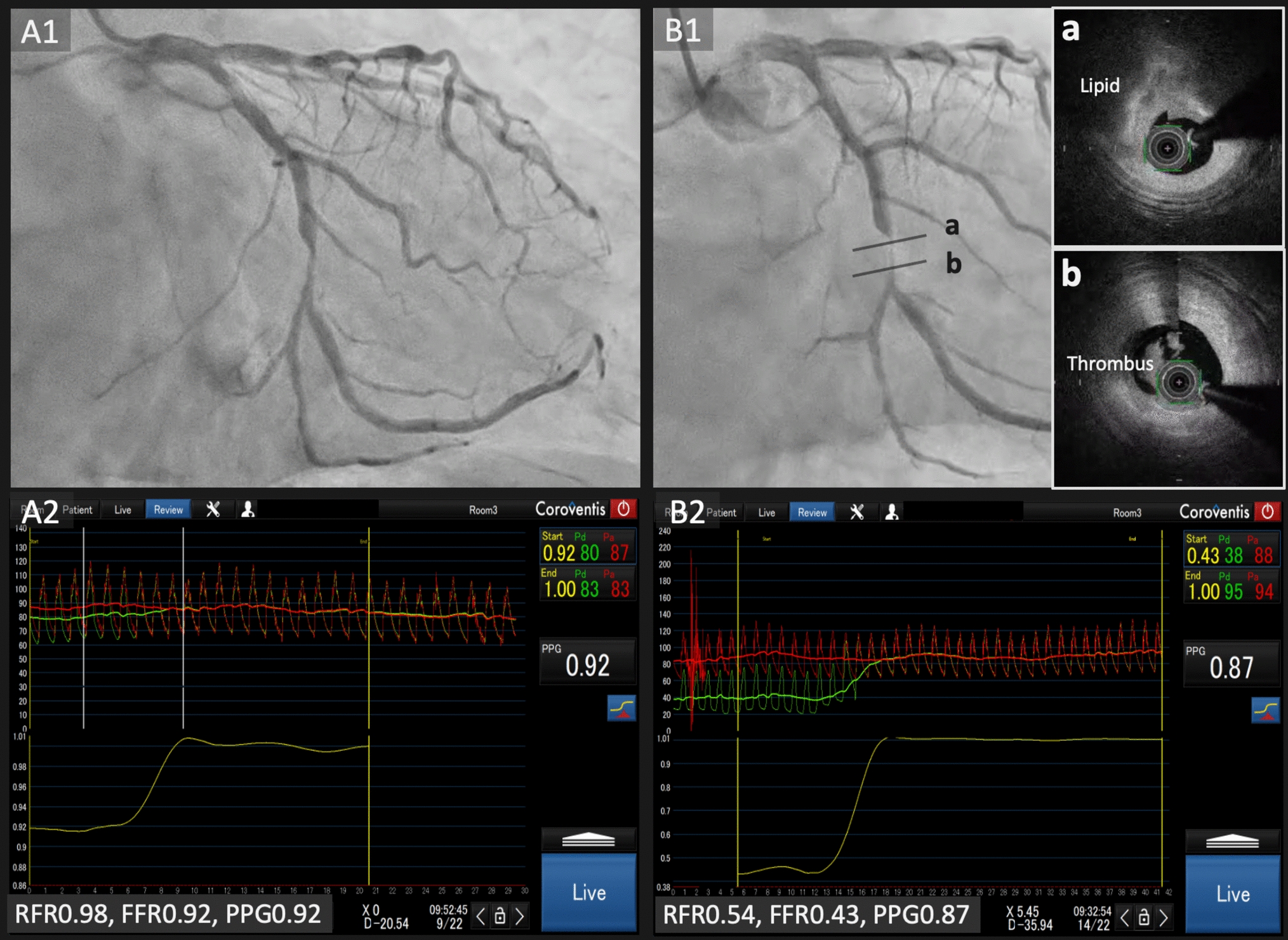Unmasking the hidden risk: potential implication of pullback pressure gradient in ischemia-negative lesions