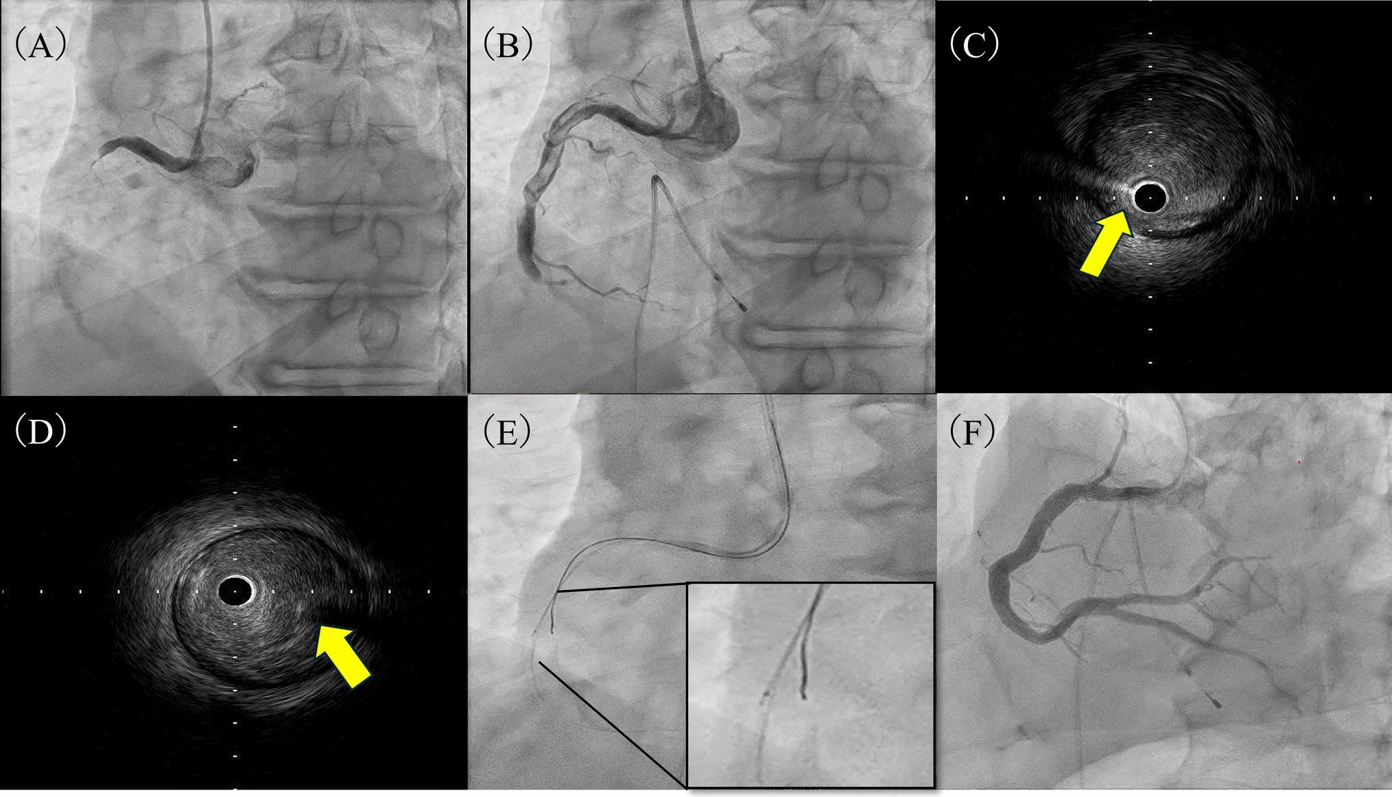 The novel strategy to acute coronary syndrome with resistant massive thrombus