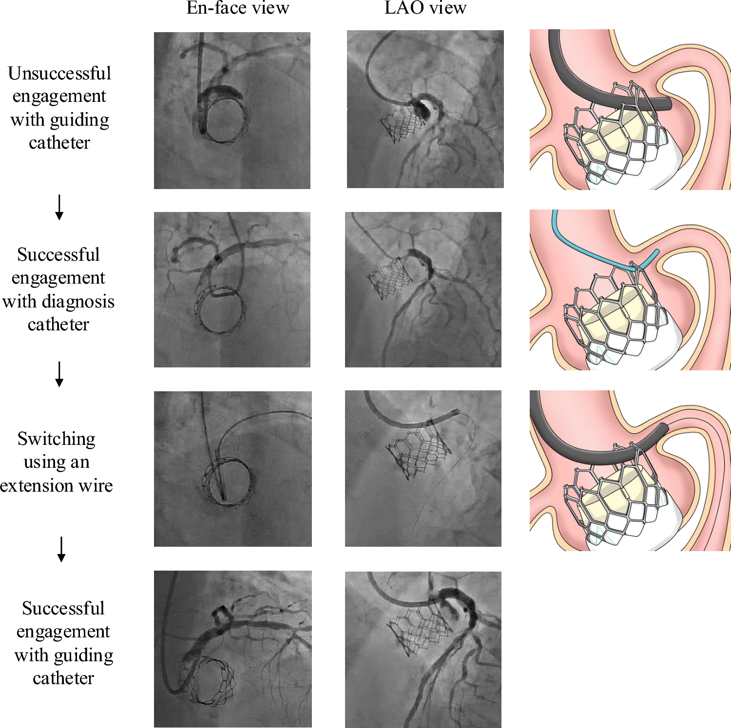 Feasibility of guiding catheter exchange using extension wire in percutaneous coronary intervention after transcatheter aortic valve replacement