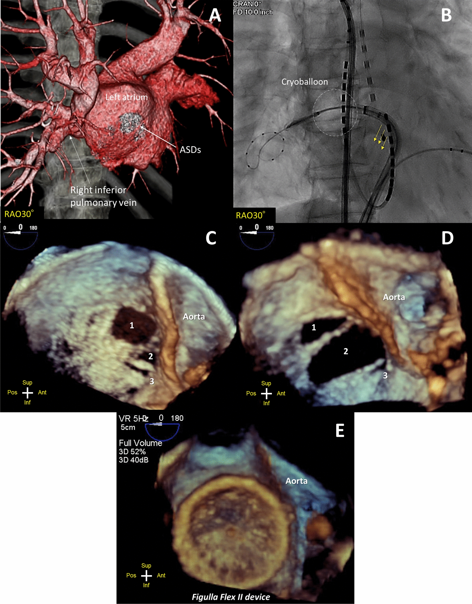 Iatrogenic laceration of the atrial septum during catheter ablation for atrial fibrillation in a patient with multiple atrial septal defects